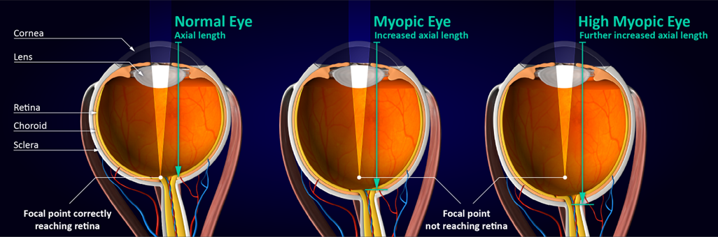 赤色光療法による近視進行抑制のメカニズム